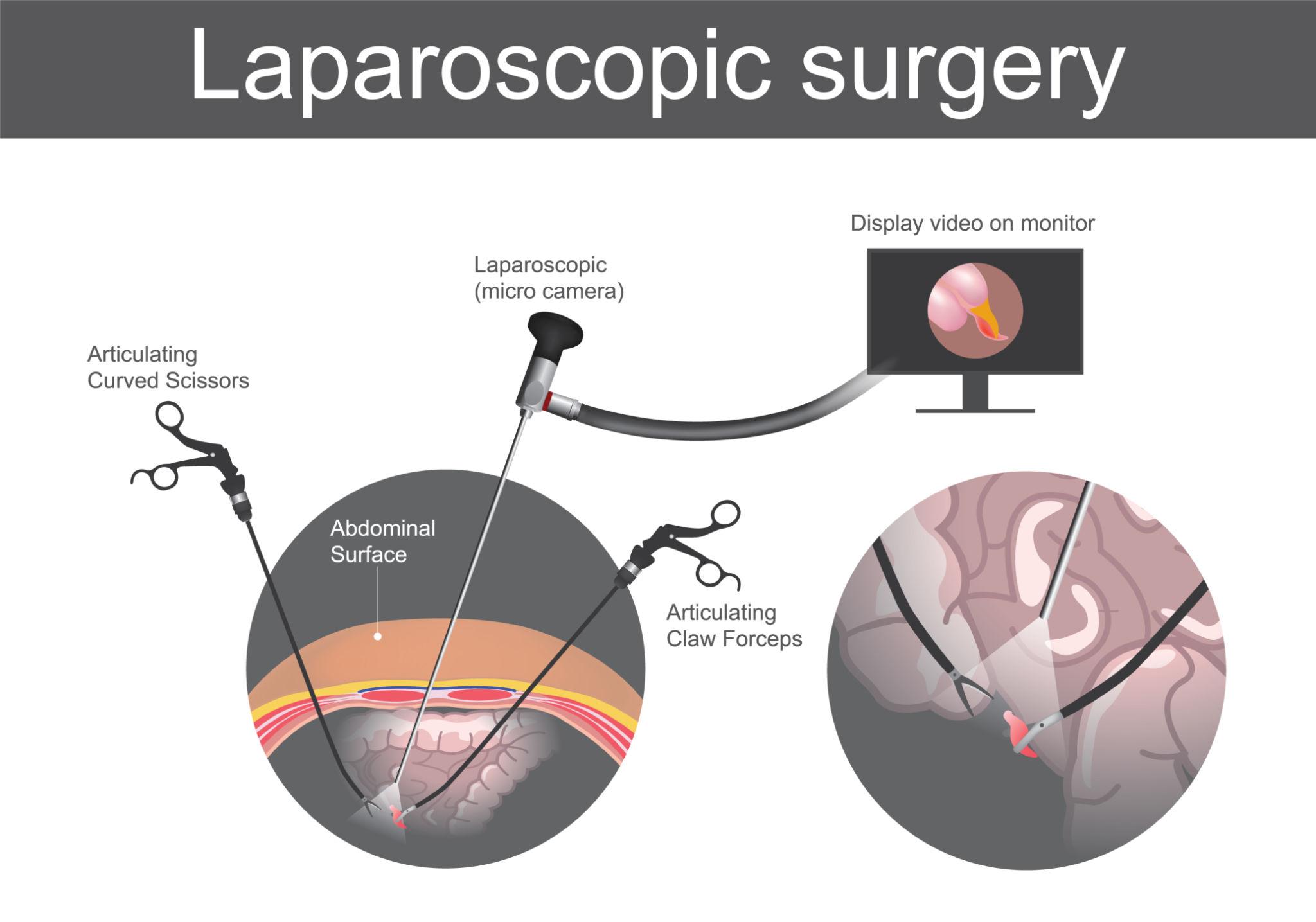 Top Gynec Laparoscopic Surgeon in Pune for Advanced Women’s Care
